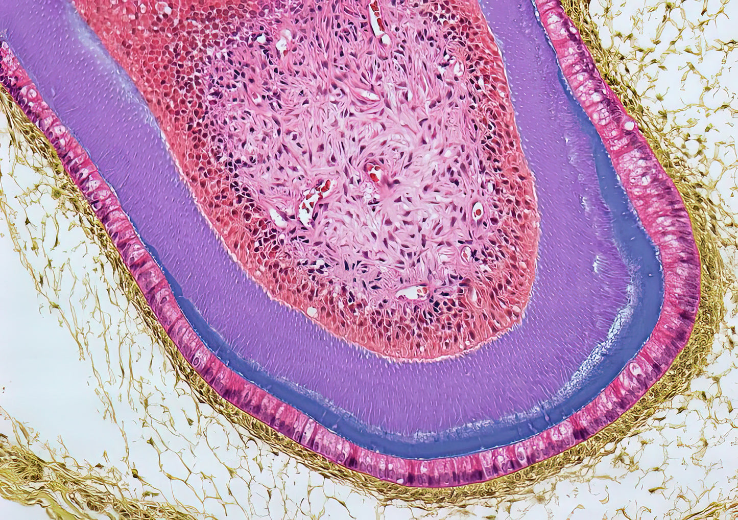 Dermoid Ovarian Cyst #5 Art Print | Medical Illustration | RedKalion